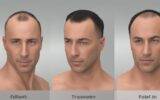 fue hair transplant